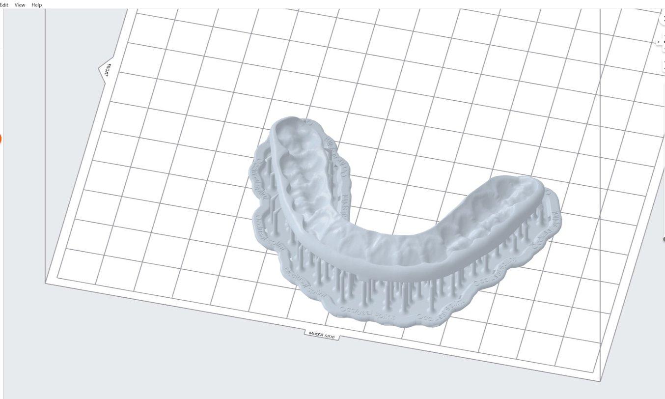 Set-up of the occlusal splint in PreForm as per the Application Guide.