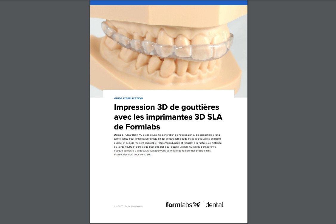 Impression 3D de gouttières avec les imprimantes 3D SLA de Formlabs