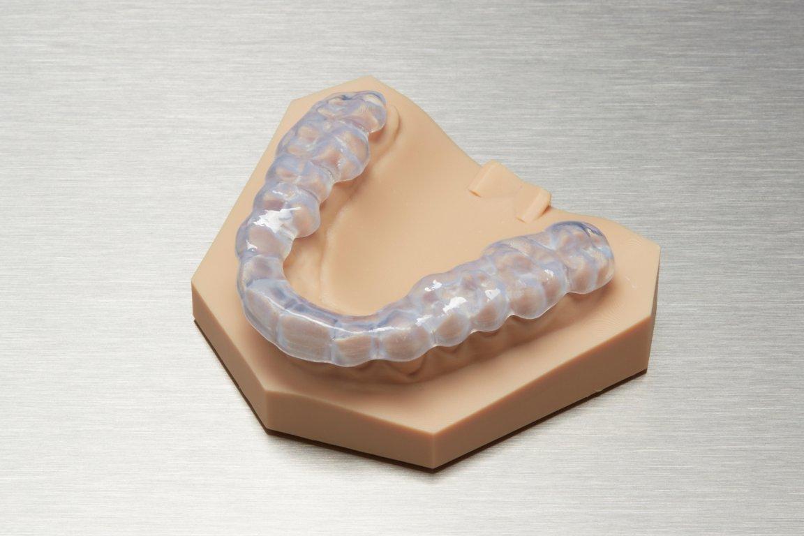 Gouttière occlusale imprimée en Dental LT Clear Resin, sur un modèle de diagnostic.