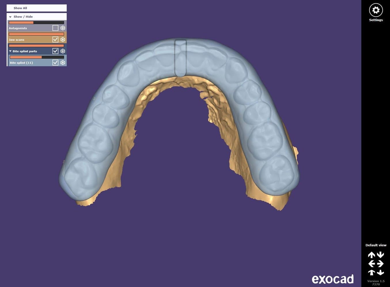 Gouttière occlusale conçue dans exocad par le service de conception (Evident)