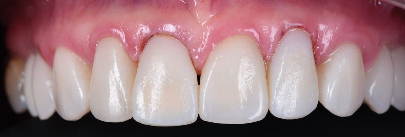 3D printed anterior veneers in the mouth
