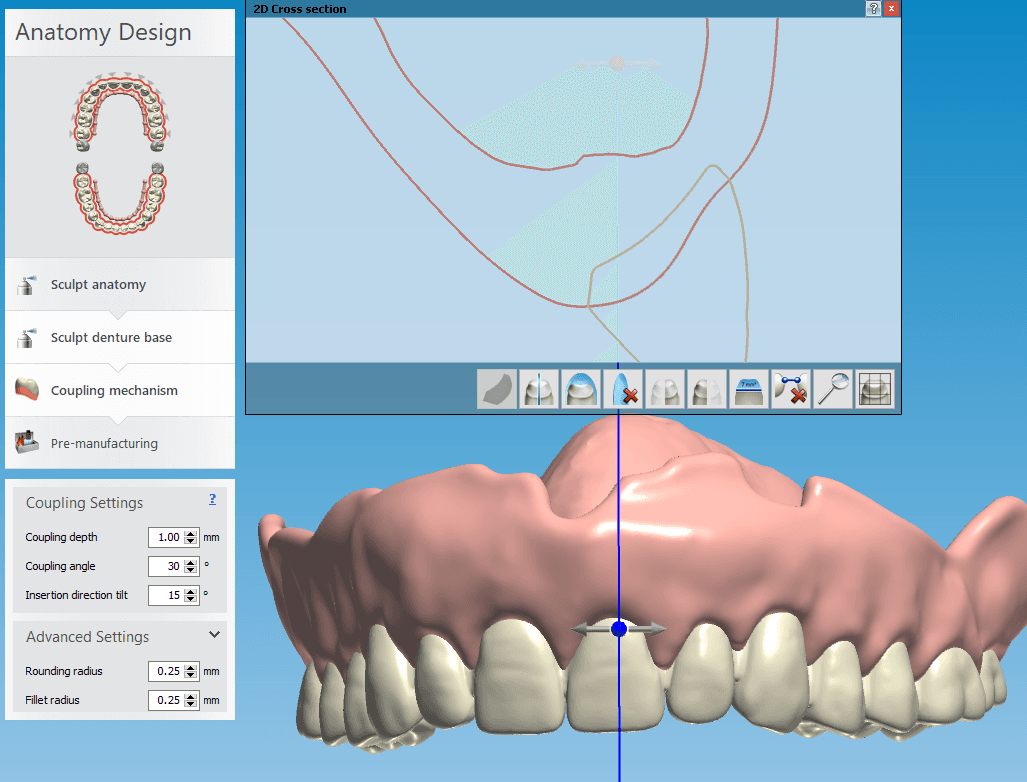 Kritische Dickebereiche einer digitalen Zahnprothese.