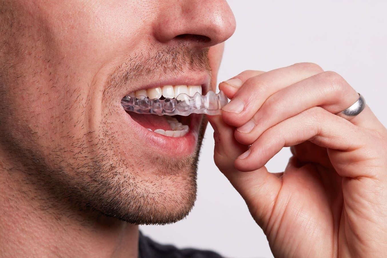 Person putting in an occlusal splint