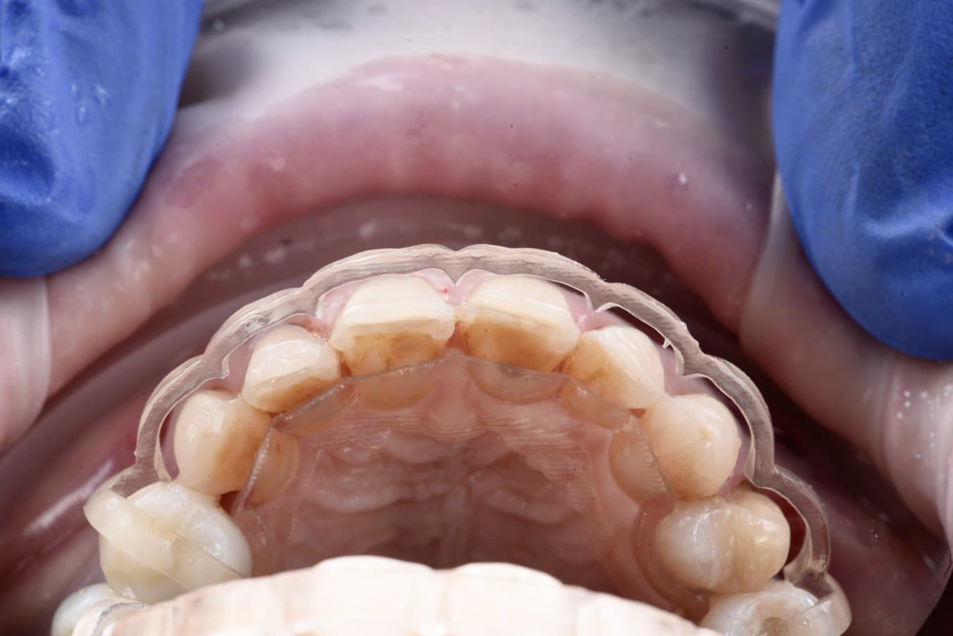 A clear, 3D printed reduction guide in the mouth