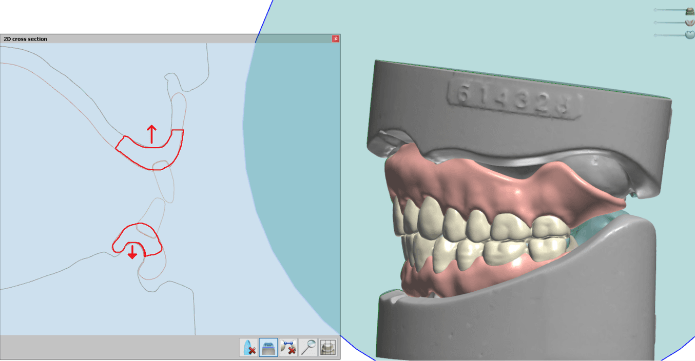 Kritische Dickebereiche einer digitalen Zahnprothese.