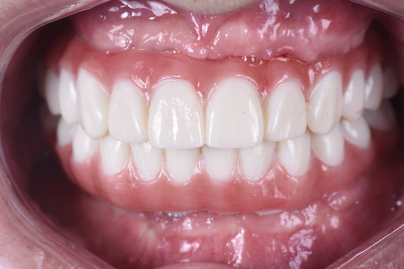 Mouth showing temporary All-on-X appliances