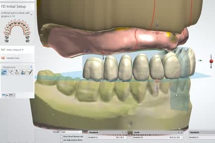 Dentures Design