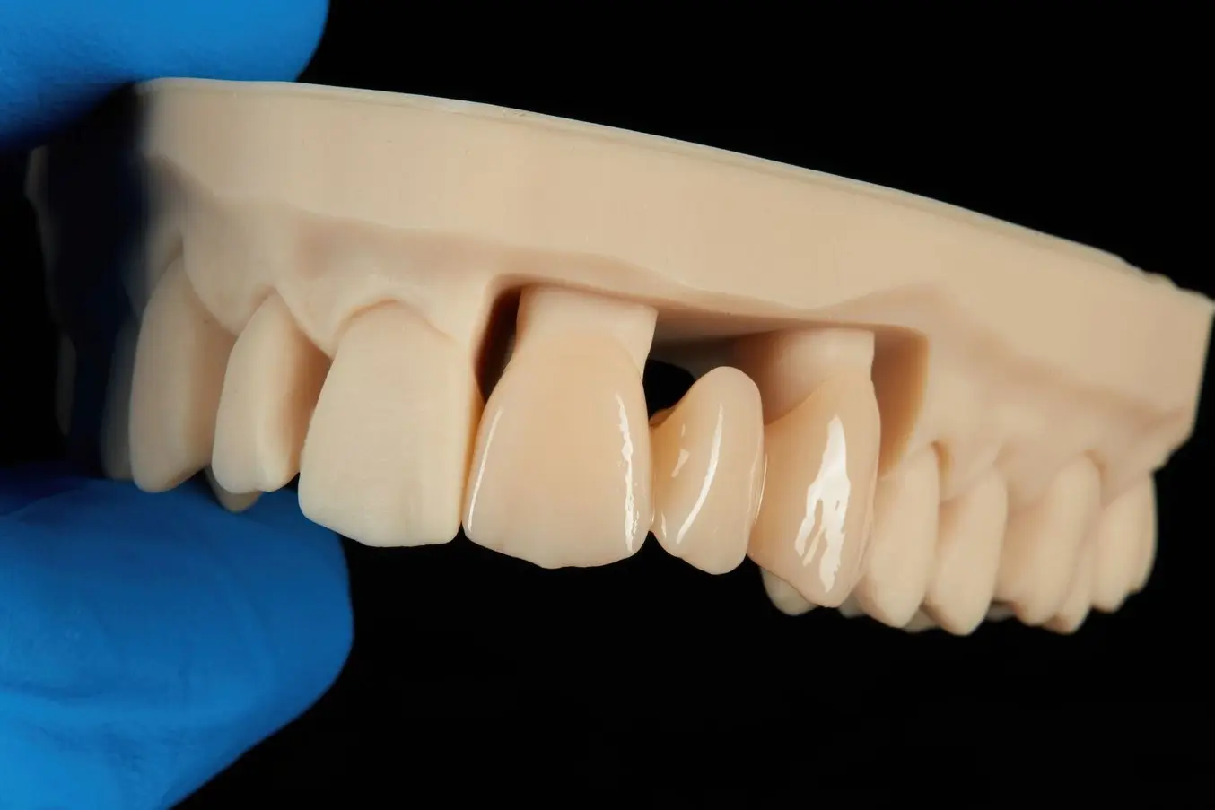 3D printed permanent crowns