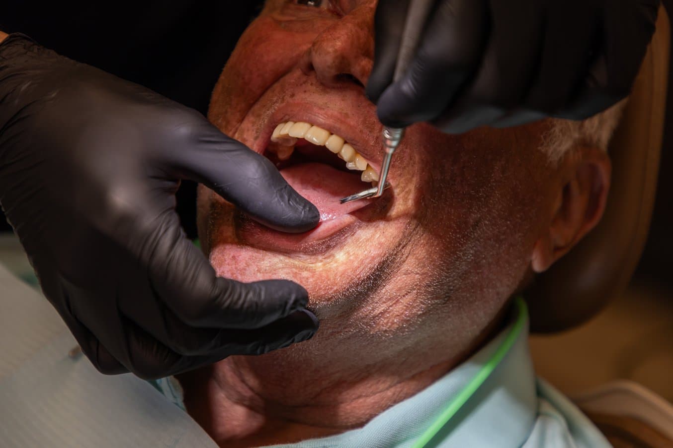 Dentist examining the 3D printed restoration in the patient's mouth