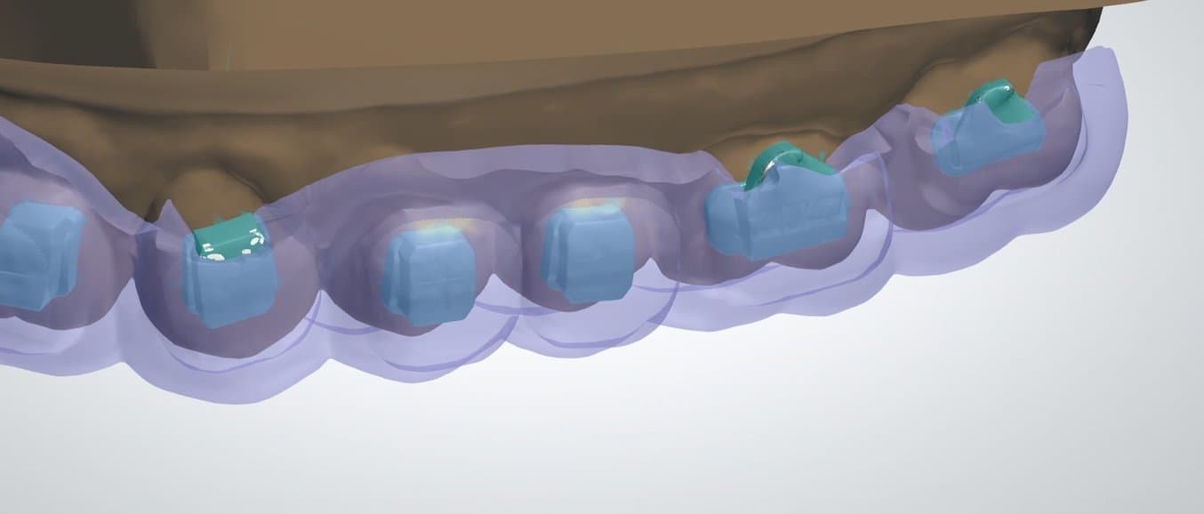 Exemple de conteneur ou couverture de brackets à trois-quarts et intégrale