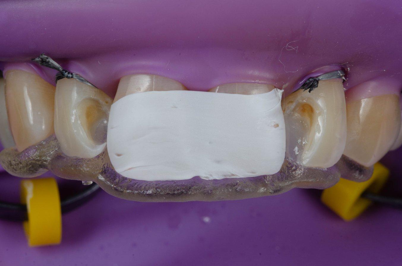 Printed palatal index used for Class III restorations of lateral incisors.