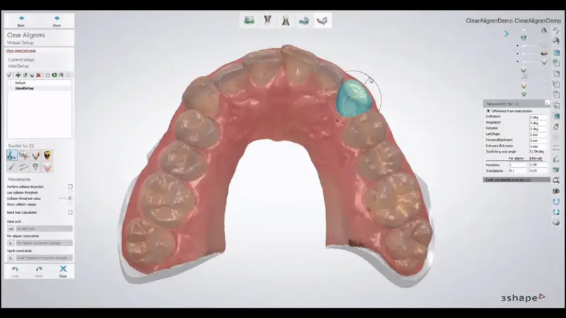 Aligner scan in 3shape