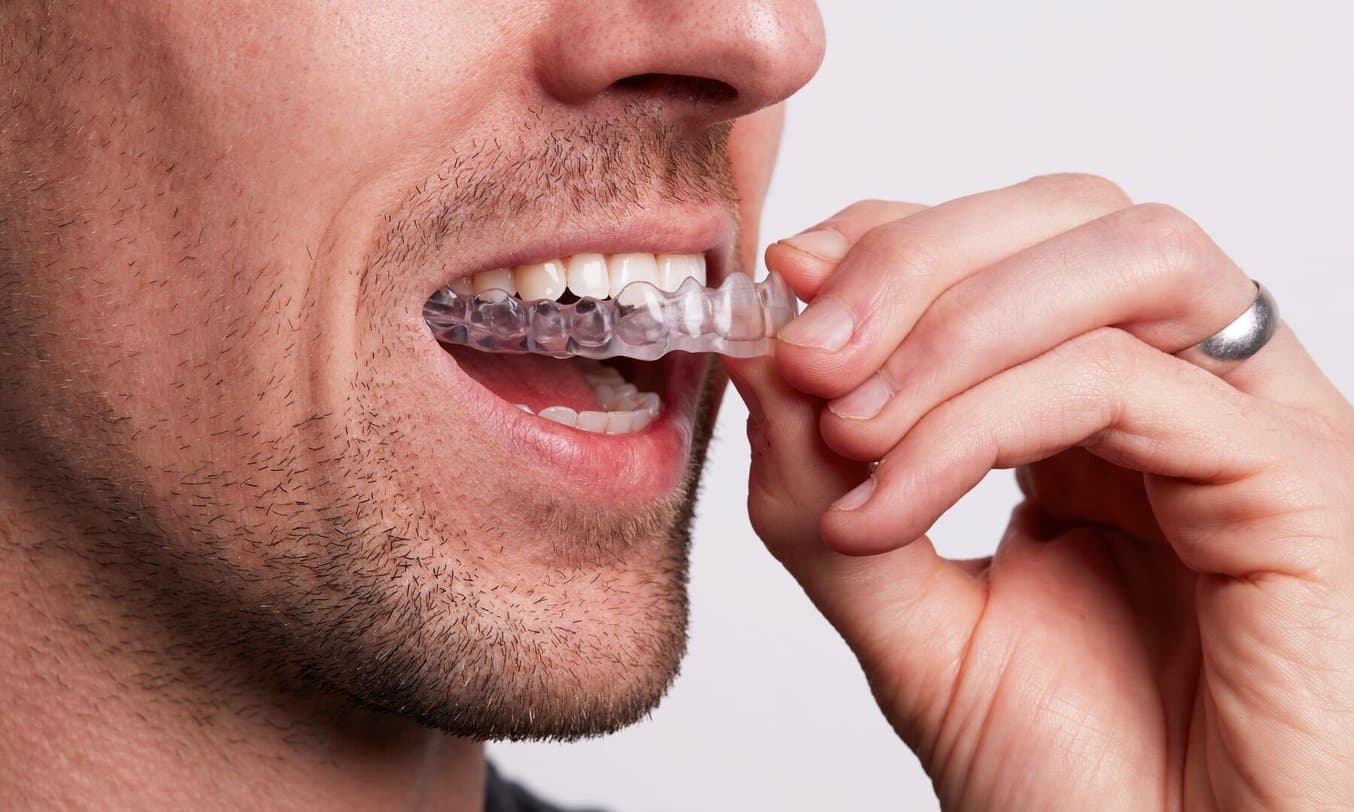 Person inserting an occlusal guard