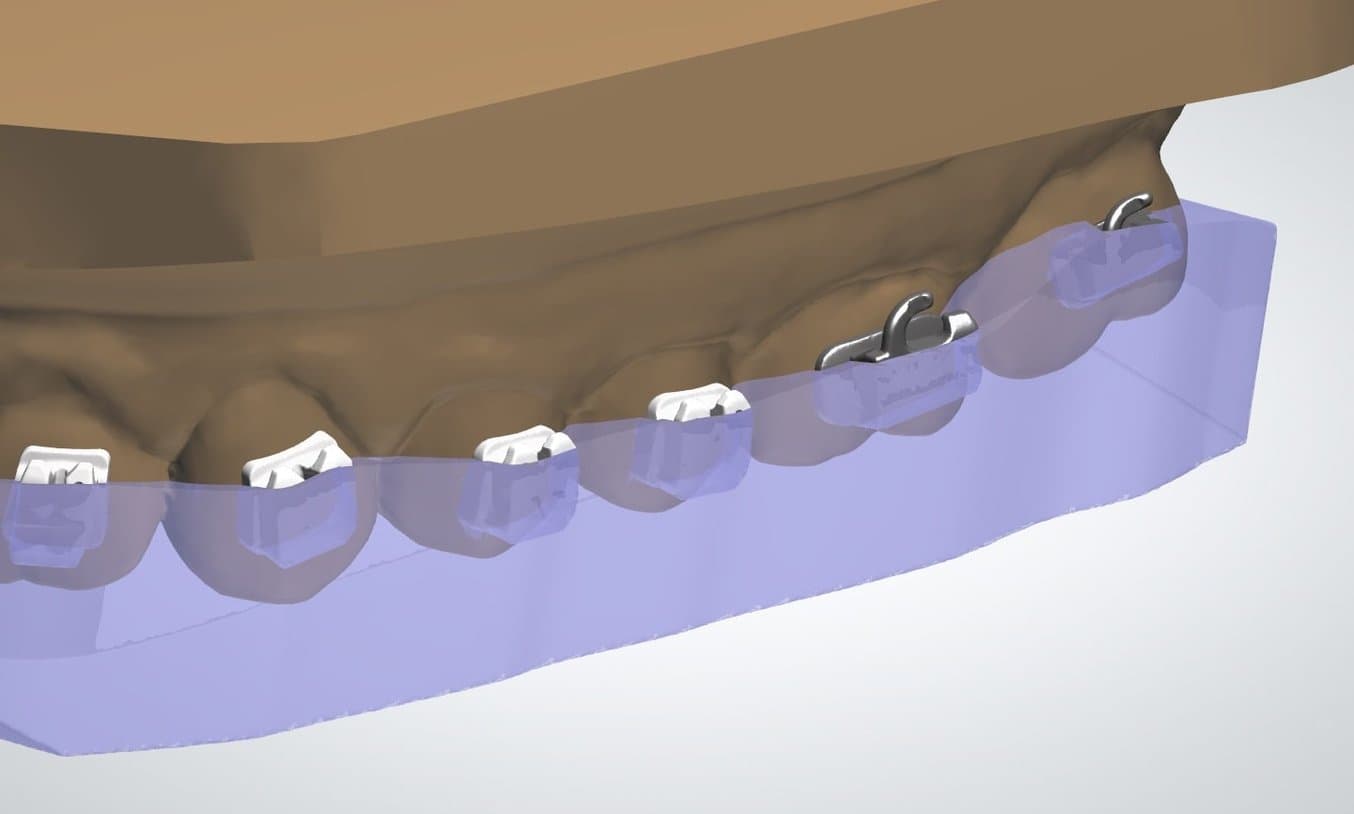 Exemple de conteneur ou couverture de brackets à moitié et à trois-quarts