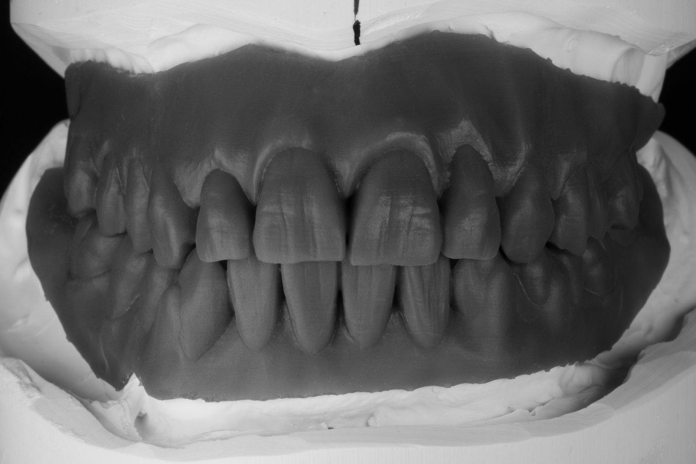 3D-gedruckter dentaler Prototyp aus Draft Resin