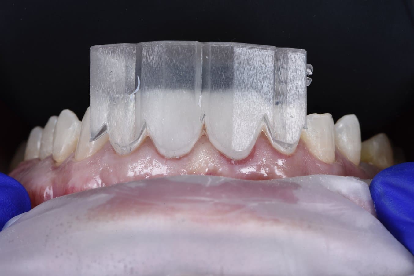 A clear, 3D printed DSD direct composite restoration guide in the mouth