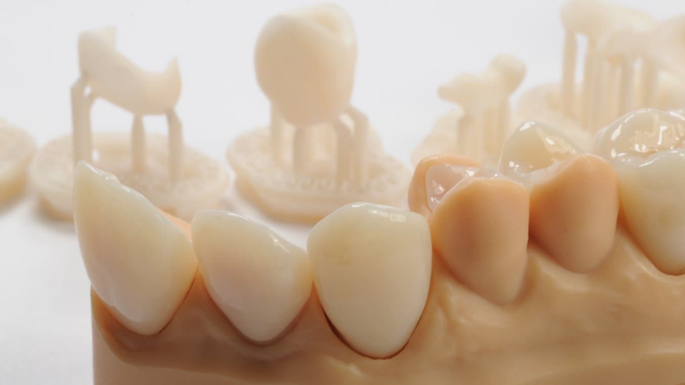 Definitive veneers and crowns prepared digitally using prosthetic