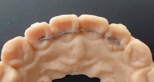A model showing a wire against the teeth of a lower arch