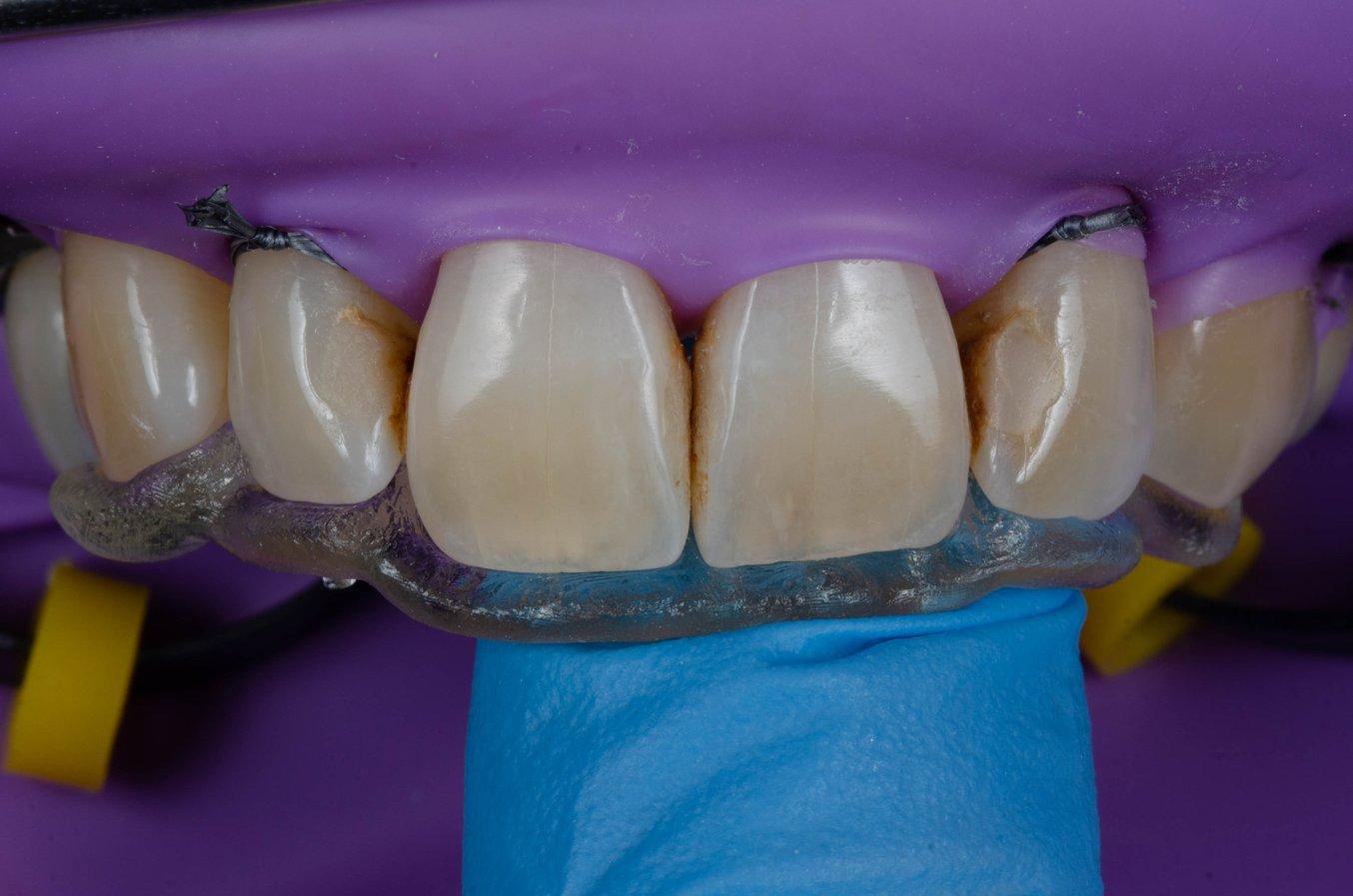 Fit check of a palatal index on front teeth in an upper jaw