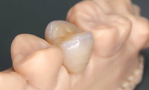 A 3D printed permanent crown on a 3D printed restorative model