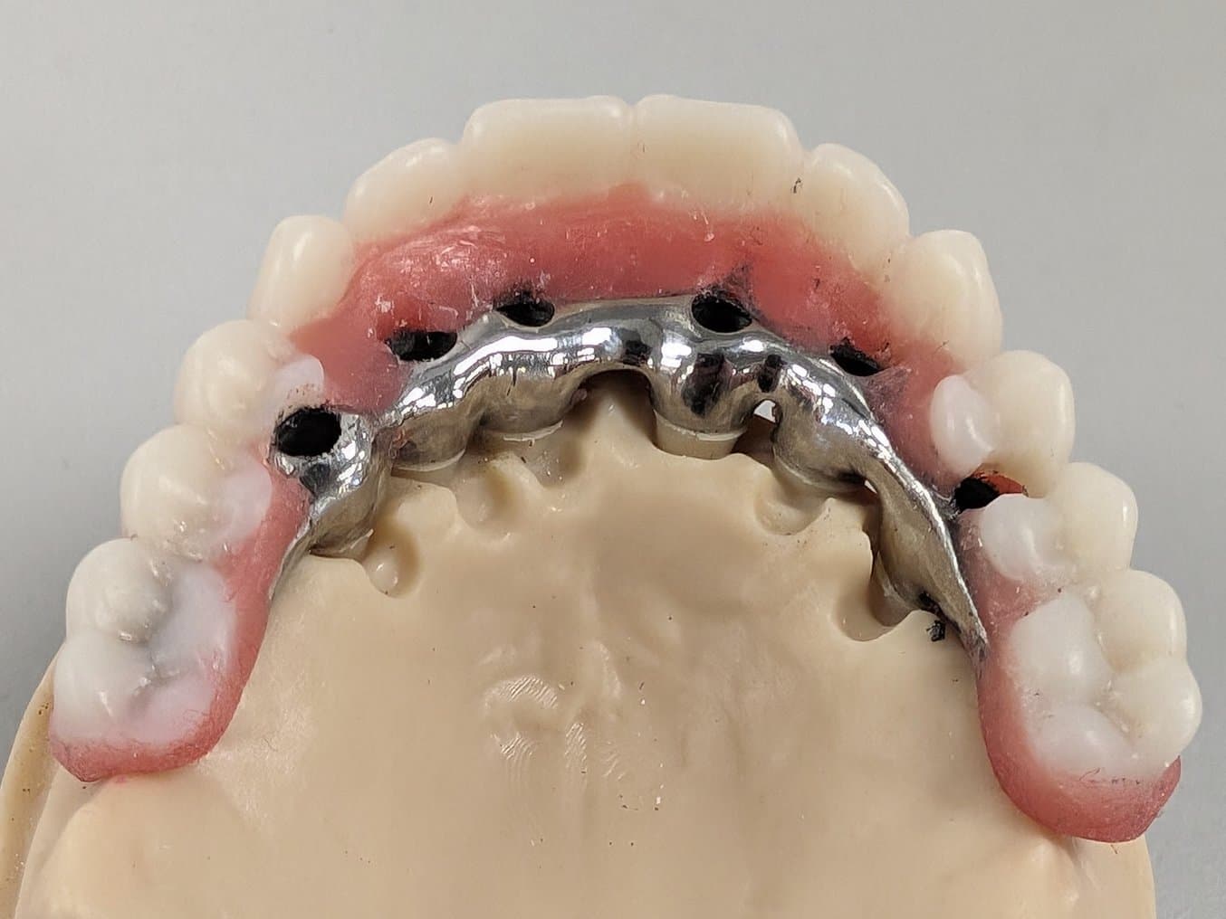 Metal component screwed directly into a 3D printed restorative model